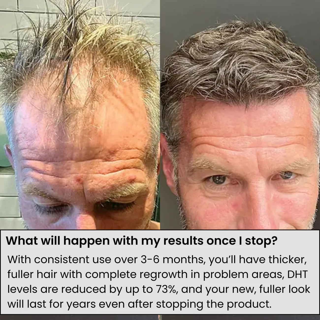 AlphaInfusion Haarwuchs System